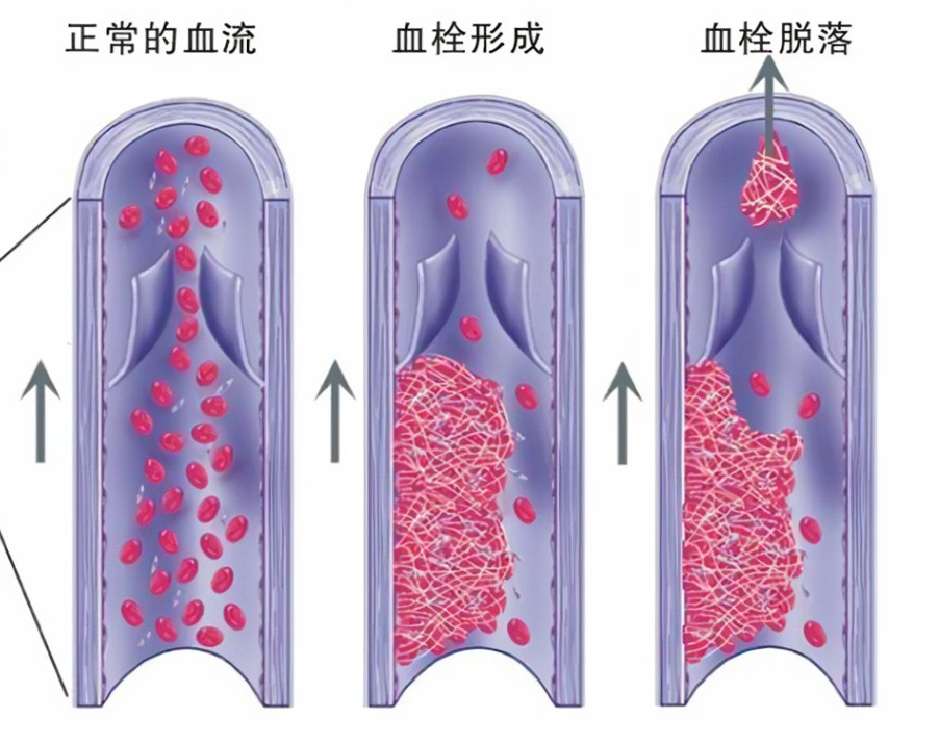 下腔深静脉血栓模型-【动物造模】 - 知乎
