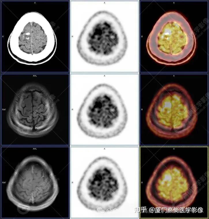 【高尚病例】PET/CT-MR 多模态融合技术在临床中的应用病例分享（一） - 知乎