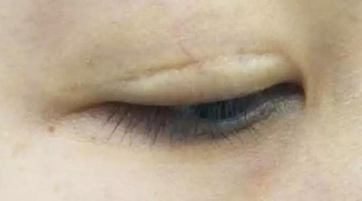 韩勋说该如何理解双眼皮修复中粘连与瘢痕