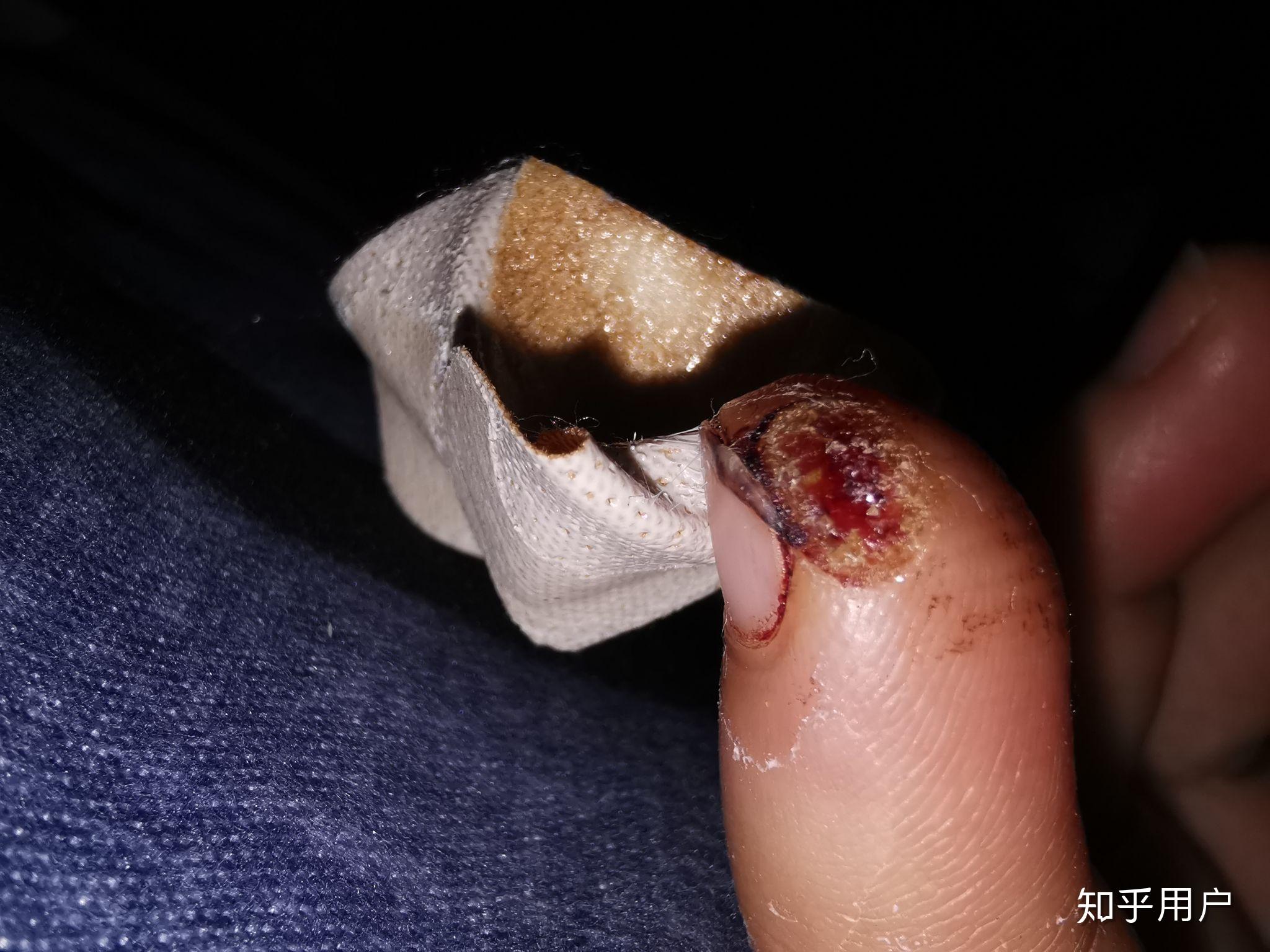 手指被割掉一块肉是什么体验? - 知乎