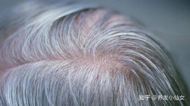 头发变白反应了衰老,年纪轻轻就白发是什么原因? - 知乎