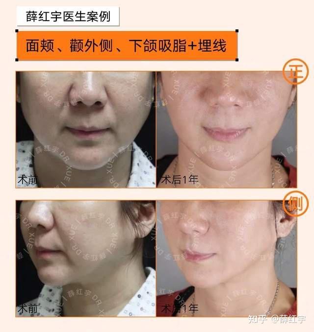 有法令纹?这9种方法治疗最有效 - 知乎