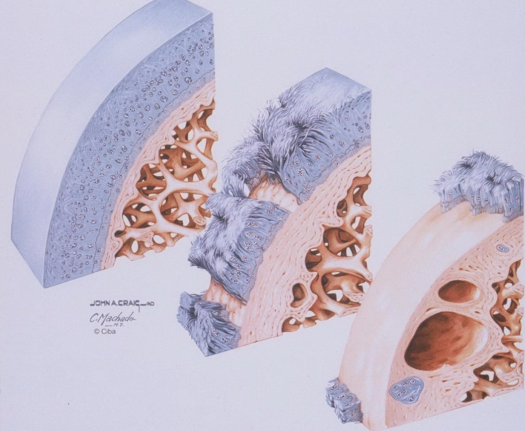药剂师学习笔记之骨关节炎osteoarthritis