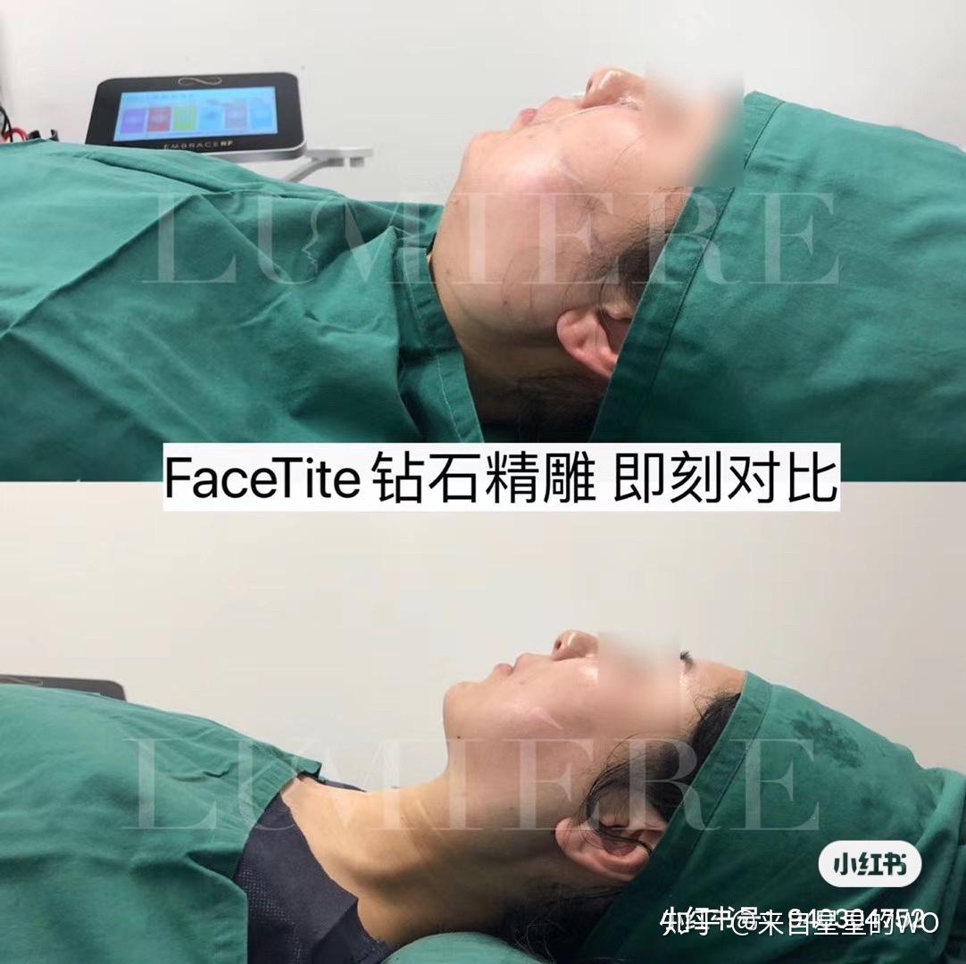 悉尼抽脂lumiere钻石精雕抽脂