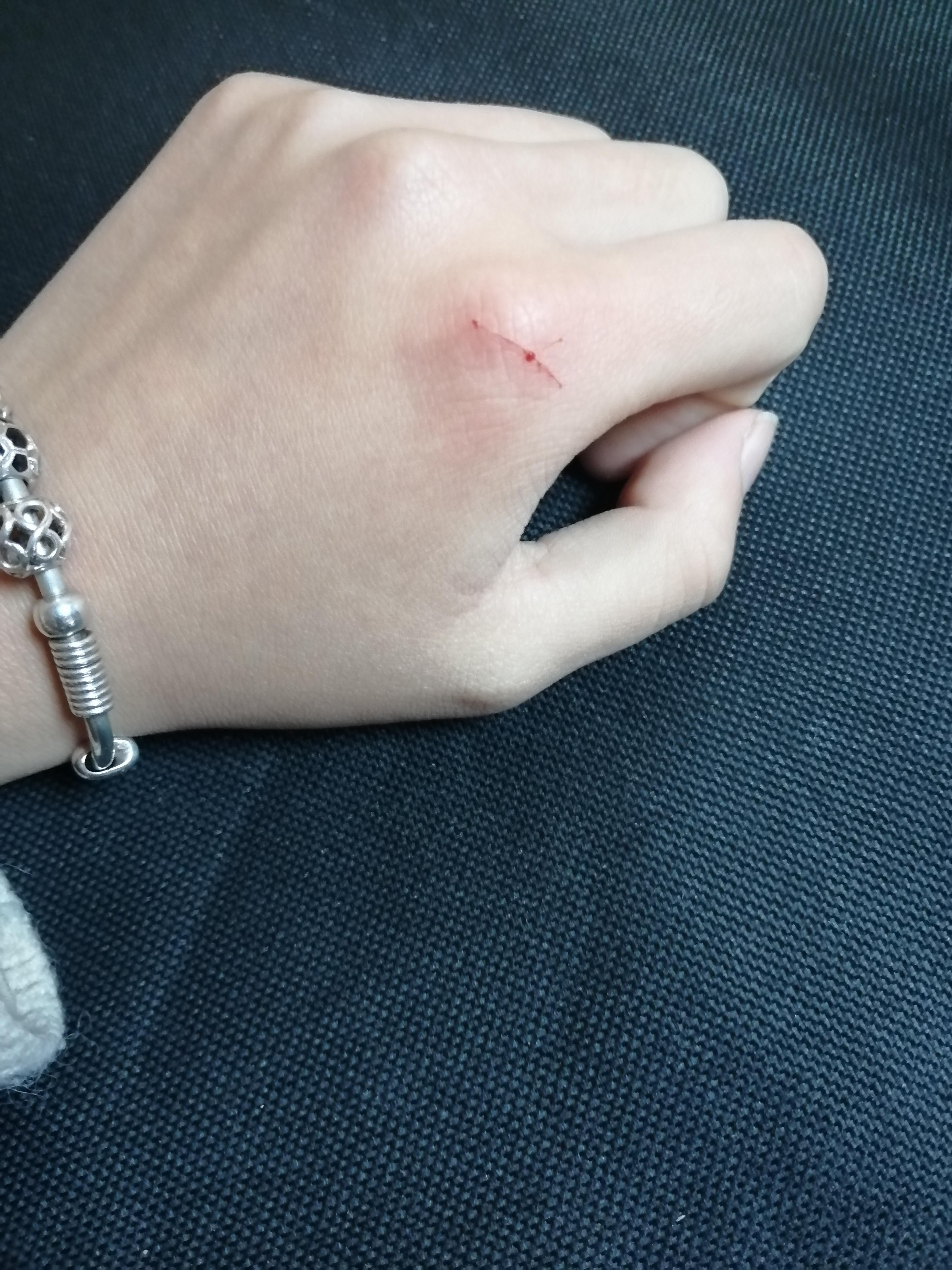 为什么身上总会出现莫名其妙的伤痕? - 知乎