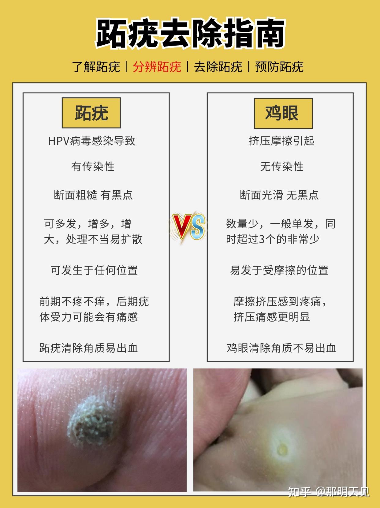 鸡眼和跖疣的区别