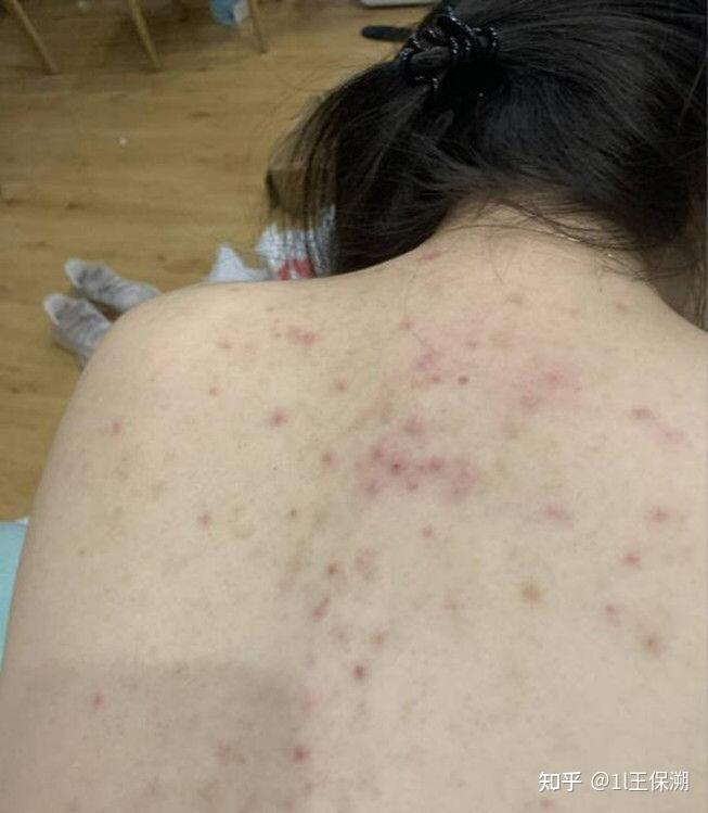 为什么有些人后背长痘痘是体质问题吗