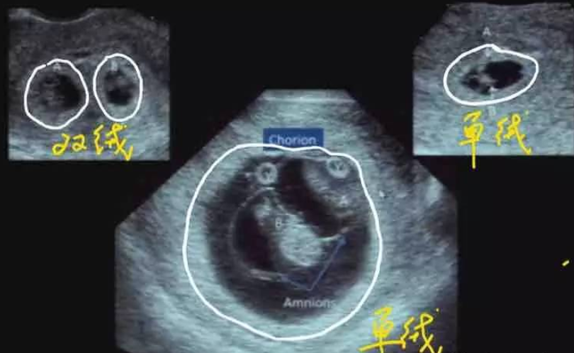 双胎绒毛膜性判断 - 知乎