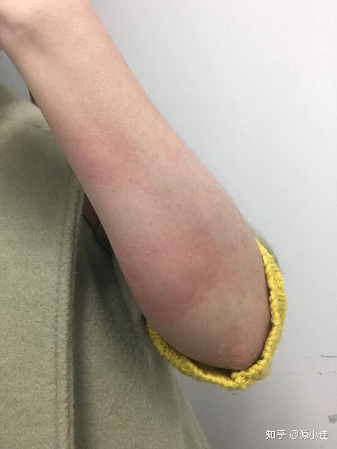 食物过敏为什么反应在面部皮肤上