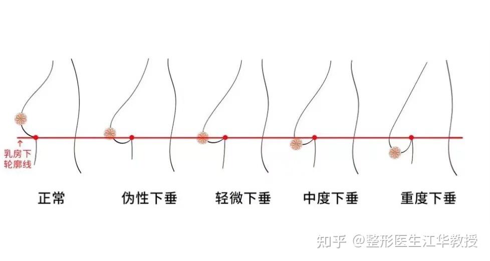 乳房下垂都是怎么看出的,分程度? - 知乎