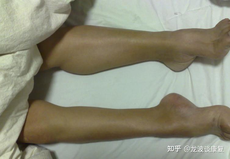 小腿部肌肉萎缩怎么恢复?具体治疗方法取决于患者的病因
