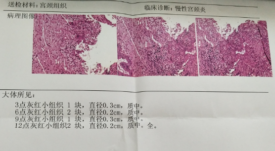 宫颈检报告大致有这几种情况 - 知乎