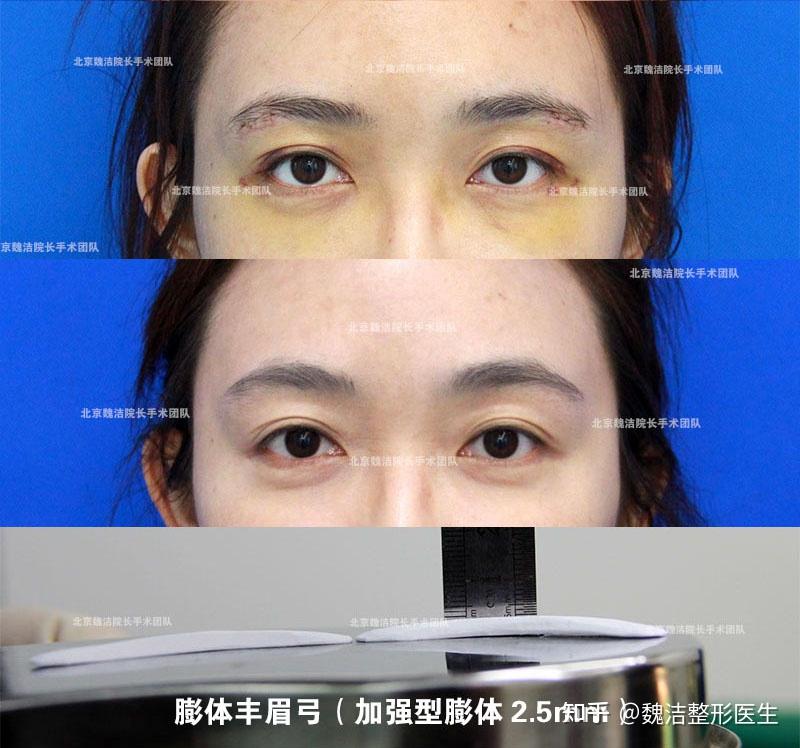 最高点2.5毫米的膨体丰眉弓案例 北京魏洁垫眉弓对比照片 - 知乎