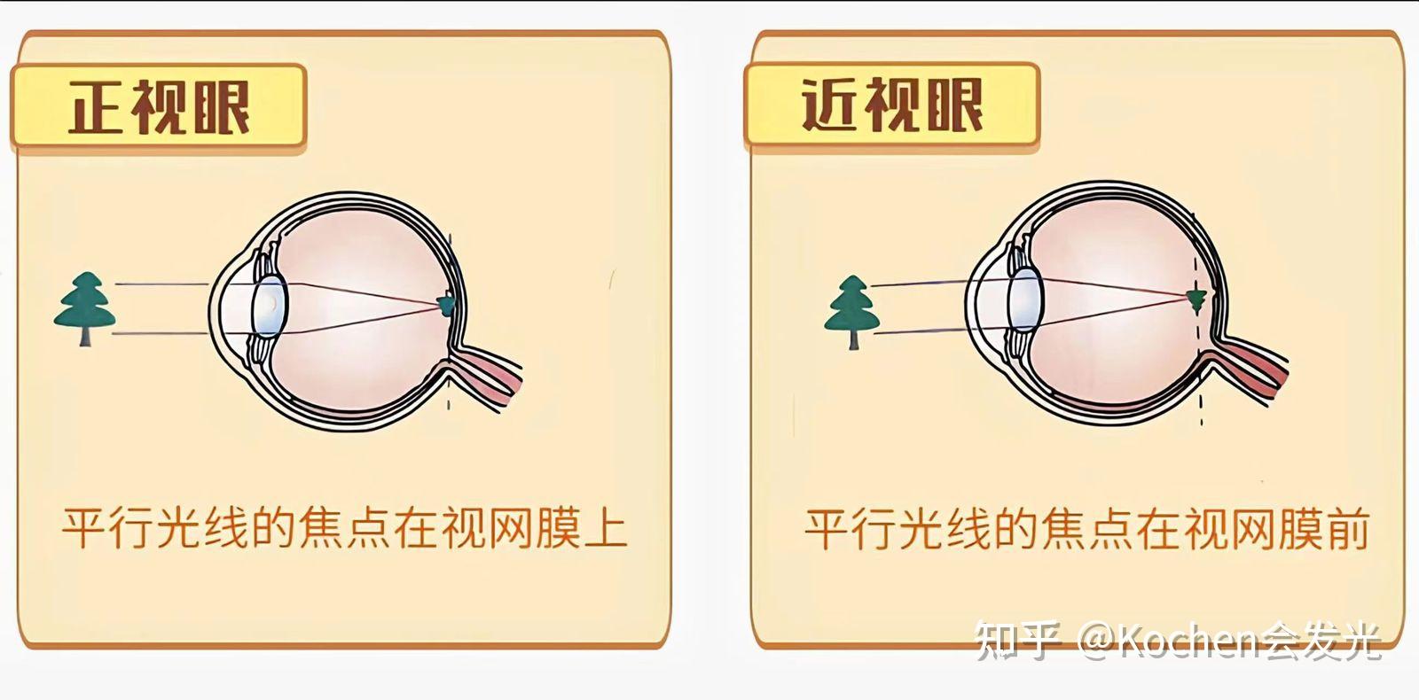 近视手术后多久可以正常用眼_厦门大学附属厦门眼科中心