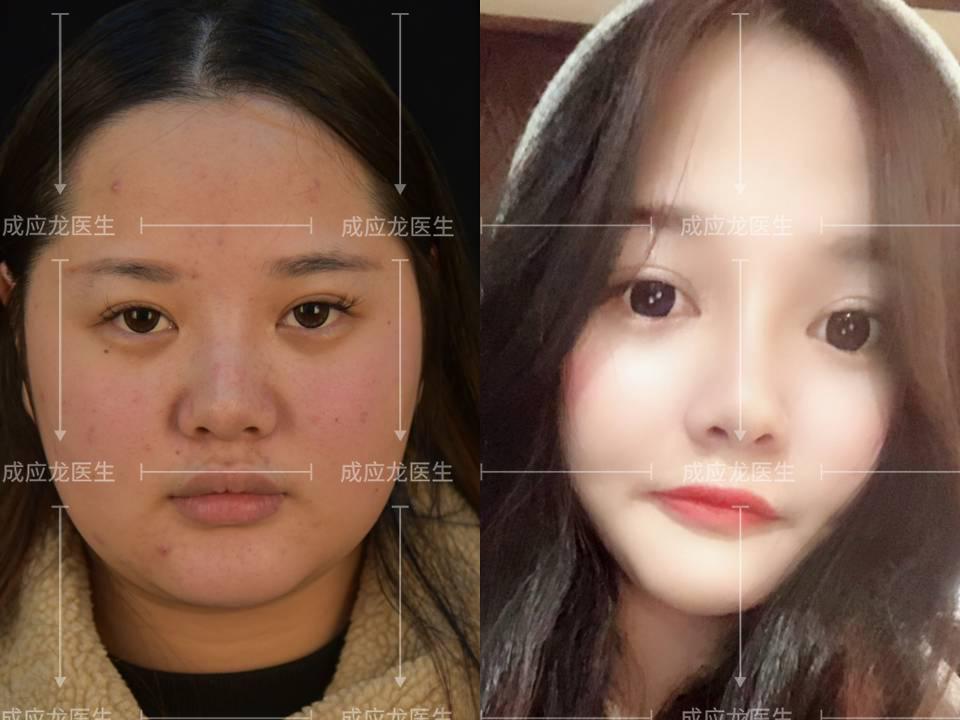 如何瘦嘴角旁的脸部 v2-84ceaa1f7b09e773a118ae3772d696b1_1440w.jpg?source=172ae18b