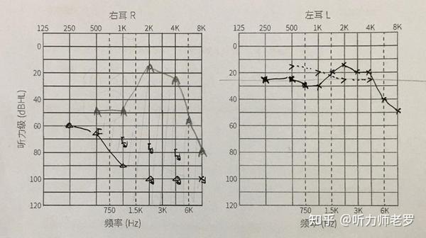 【案例分享】牙骨传导技术干预单侧听力损失（突发性聋） - 知乎