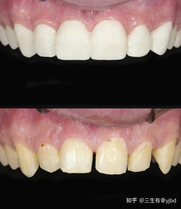 上海圣贝口腔提醒你的牙缝可能正在悄无声息的成长