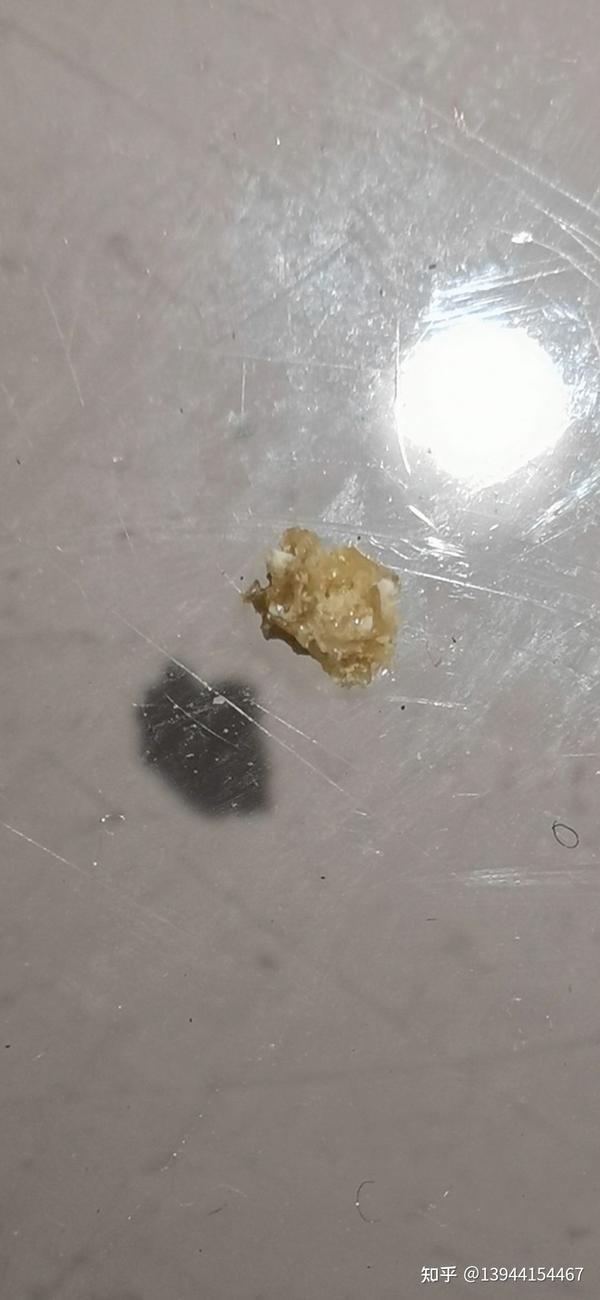 2.4cm肾结石排出过程经验分享