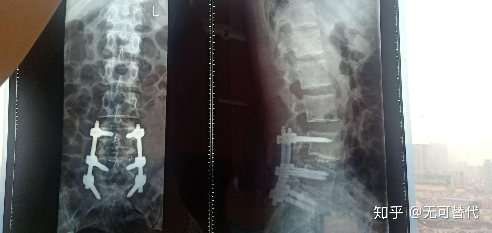 可调节胸腰椎固定支具支架腰椎骨折护腰带脊椎手术后腰部支架-阿里巴巴
