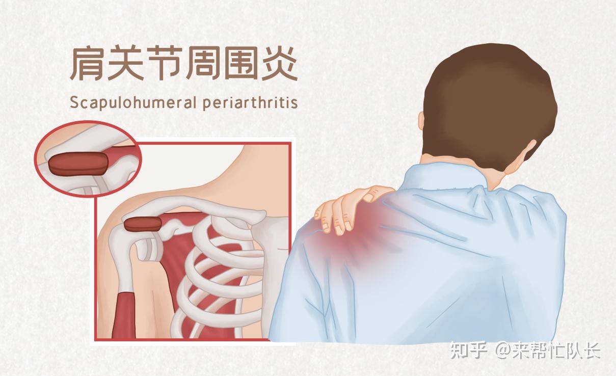 肺癌左肩疼位置图图片