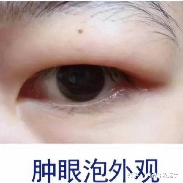 什么是肿眼泡图片