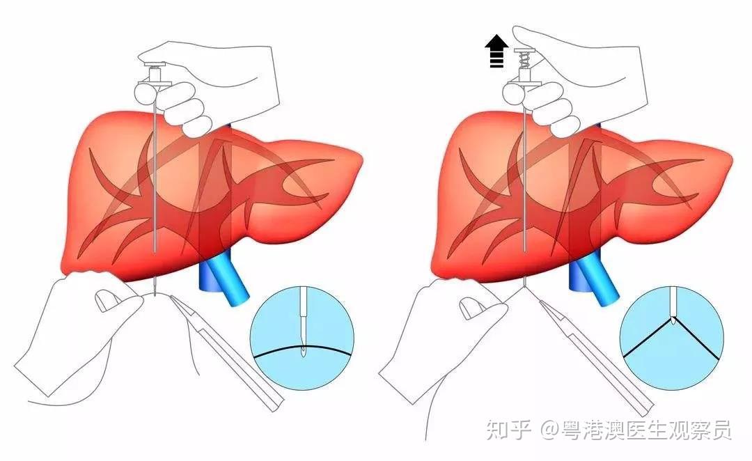 肝穿刺活检(2)发射单光子计算机断层扫描仪(spect-ct): spect/ct已
