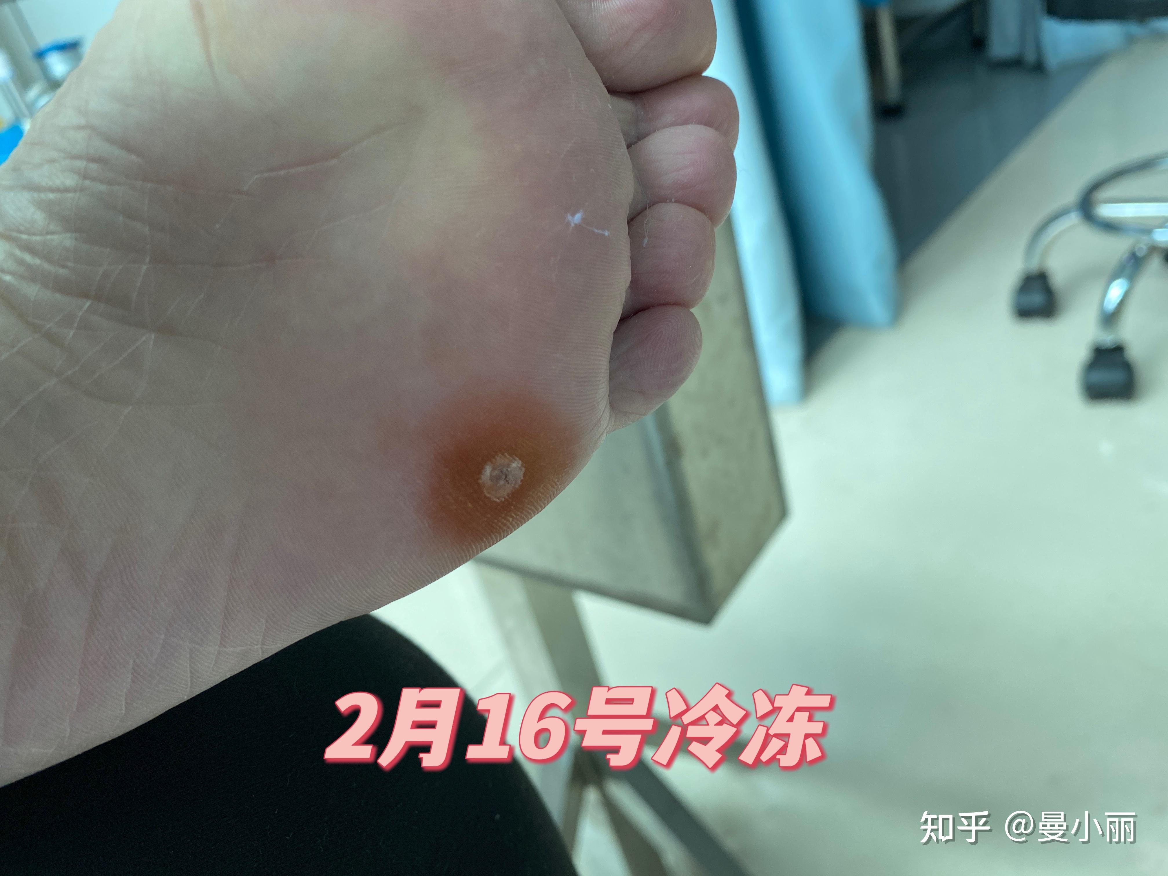 酷刑之冷冻跖疣