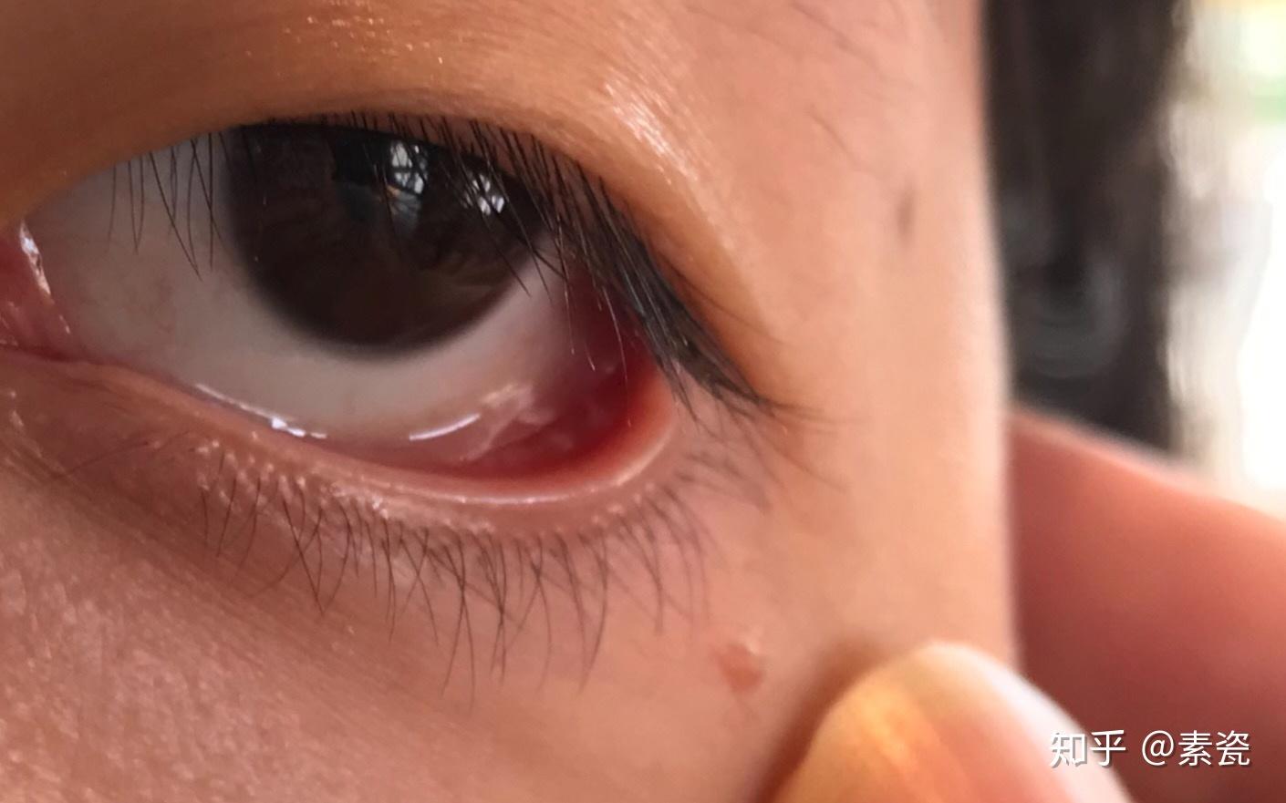 滤泡性结膜炎如何能有效治疗之前会怕光流眼泪眼干涩疼痛现在这些症状