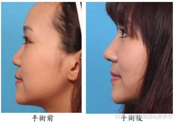 鼻部美学设计分享 - 知乎