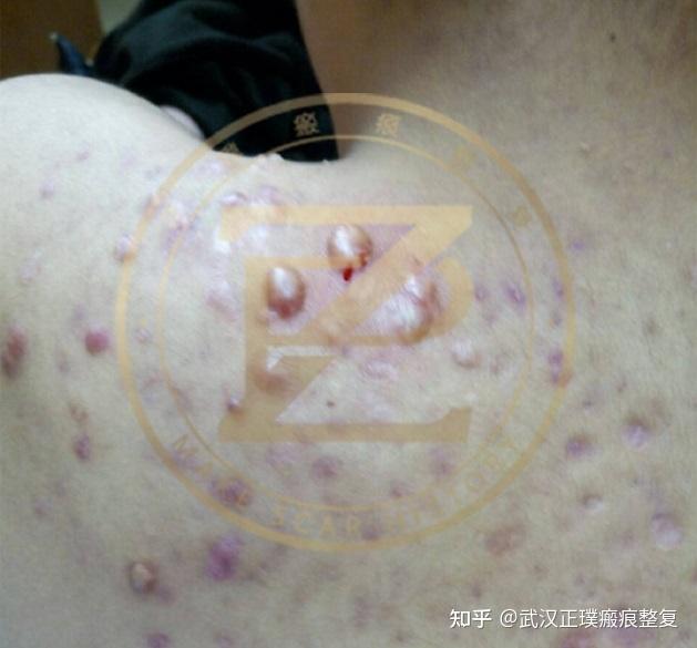 瘢痕疙瘩是一种有瘢痕体质的伤口在愈合过程中皮肤内结缔组织过度增生