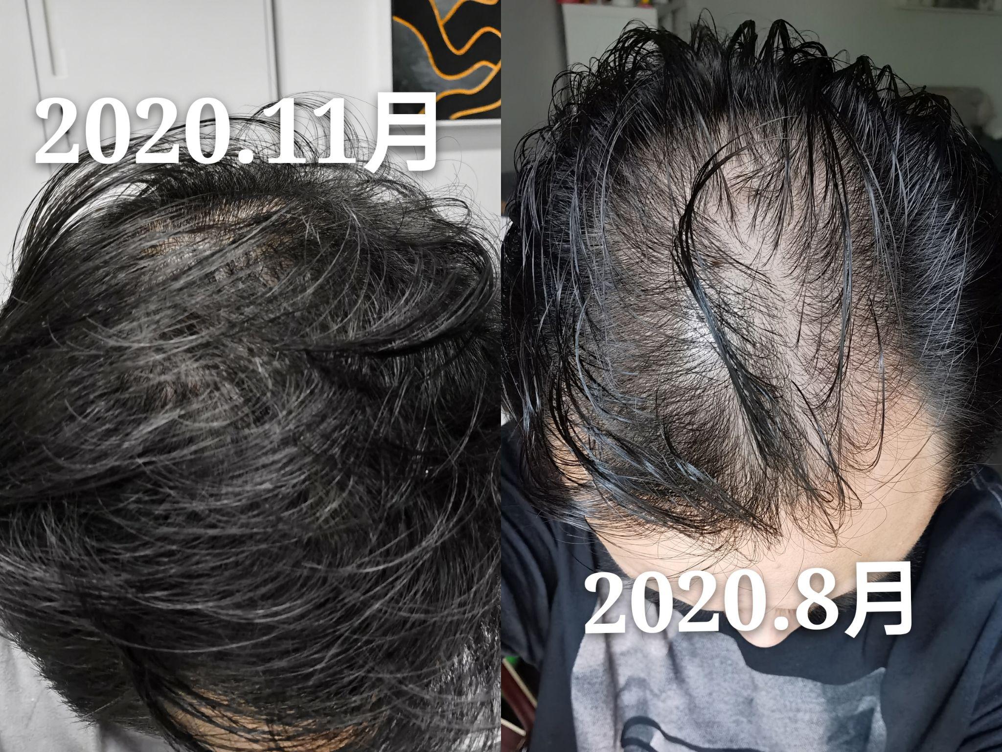 发布于 20 小时前 · 86 次播放脱发雄性激素脱发秃顶掉头