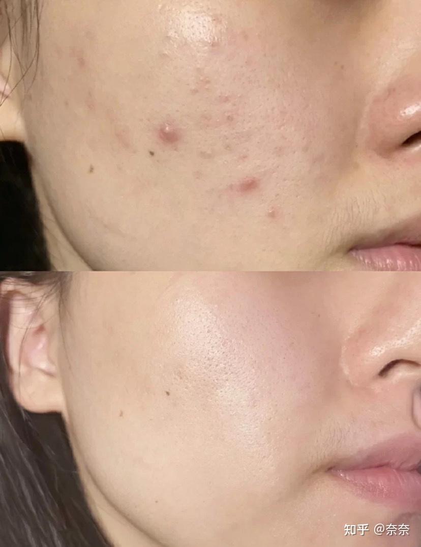 有什么很冷门却极其有效的改善皮肤状态的方法