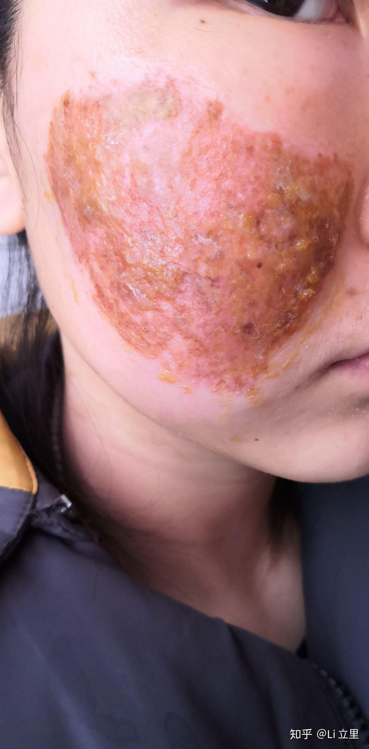 co2二氧化碳点阵激光术后