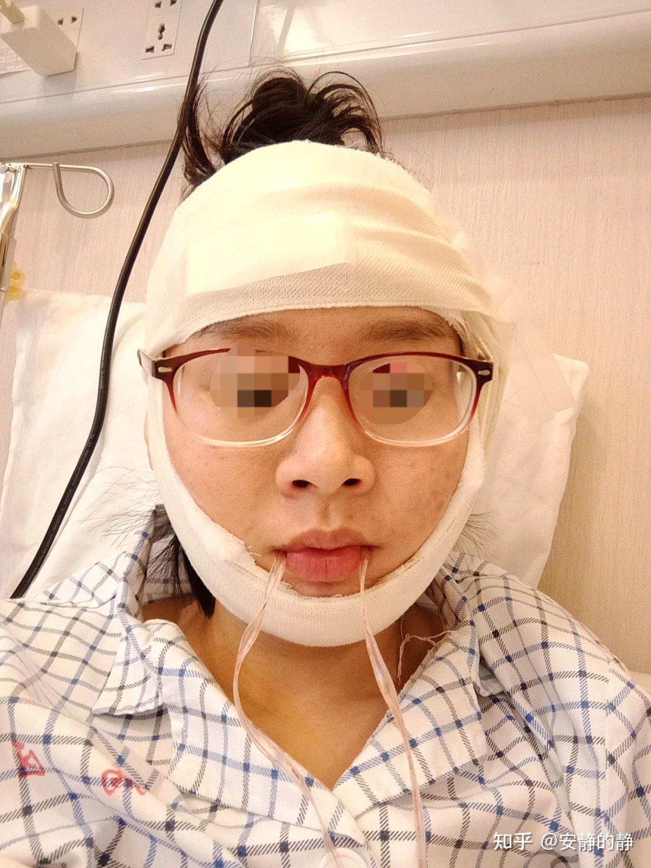 韩国磨骨经历，我近5个月来的削骨经历，削骨手术有多痛苦 - 哔哩哔哩