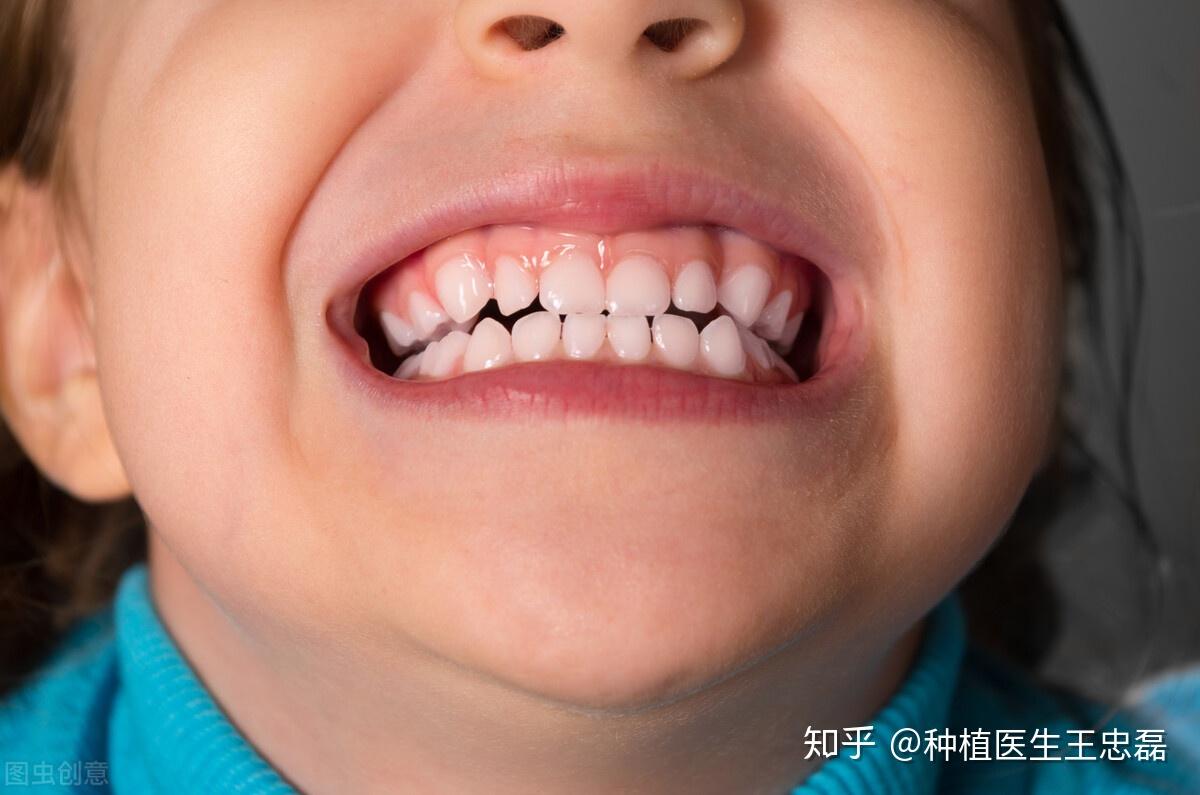 Denti cariati nei bambini: cause e trattamenti