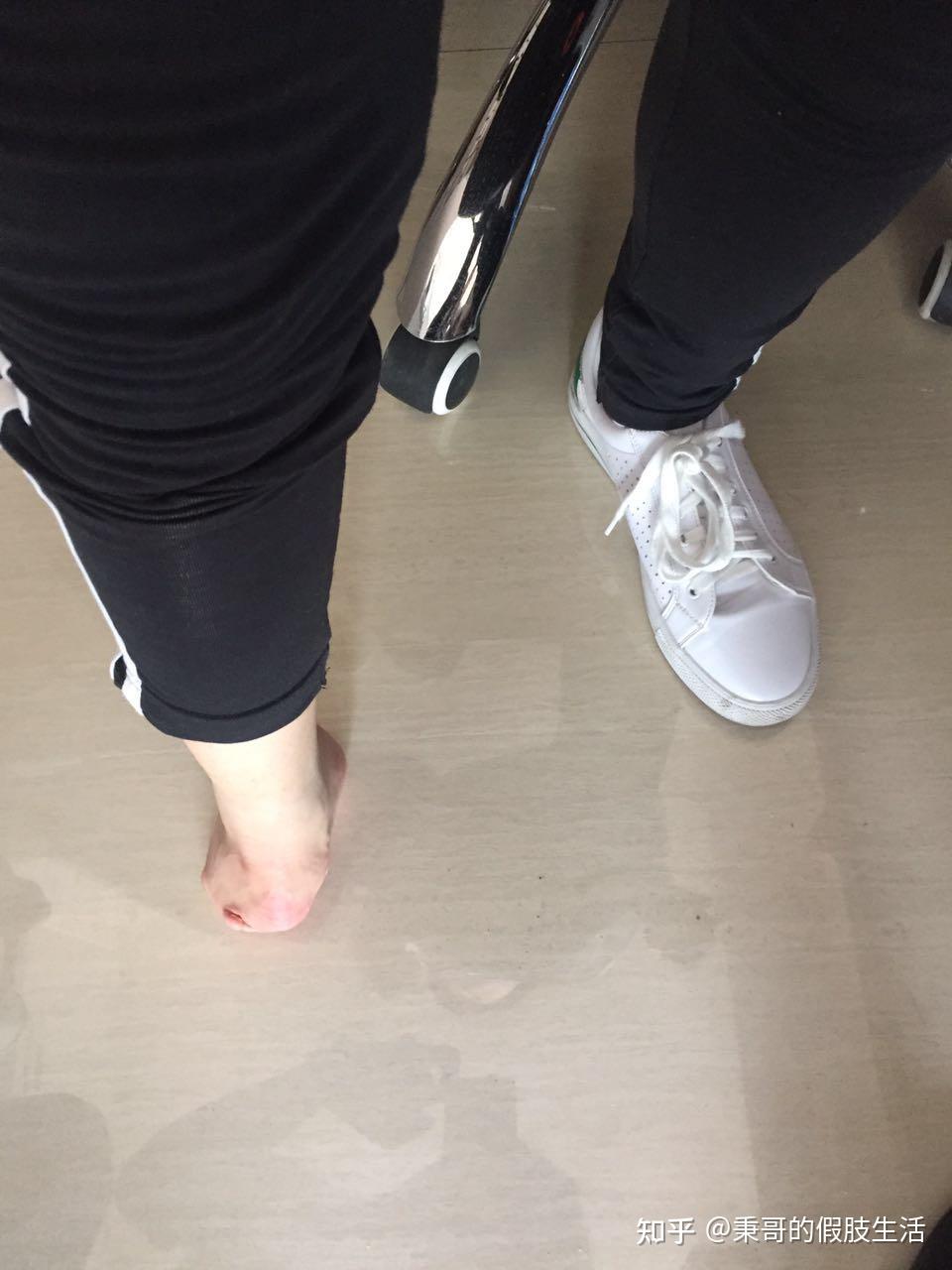 踝部截肢后应穿戴什么样的假肢