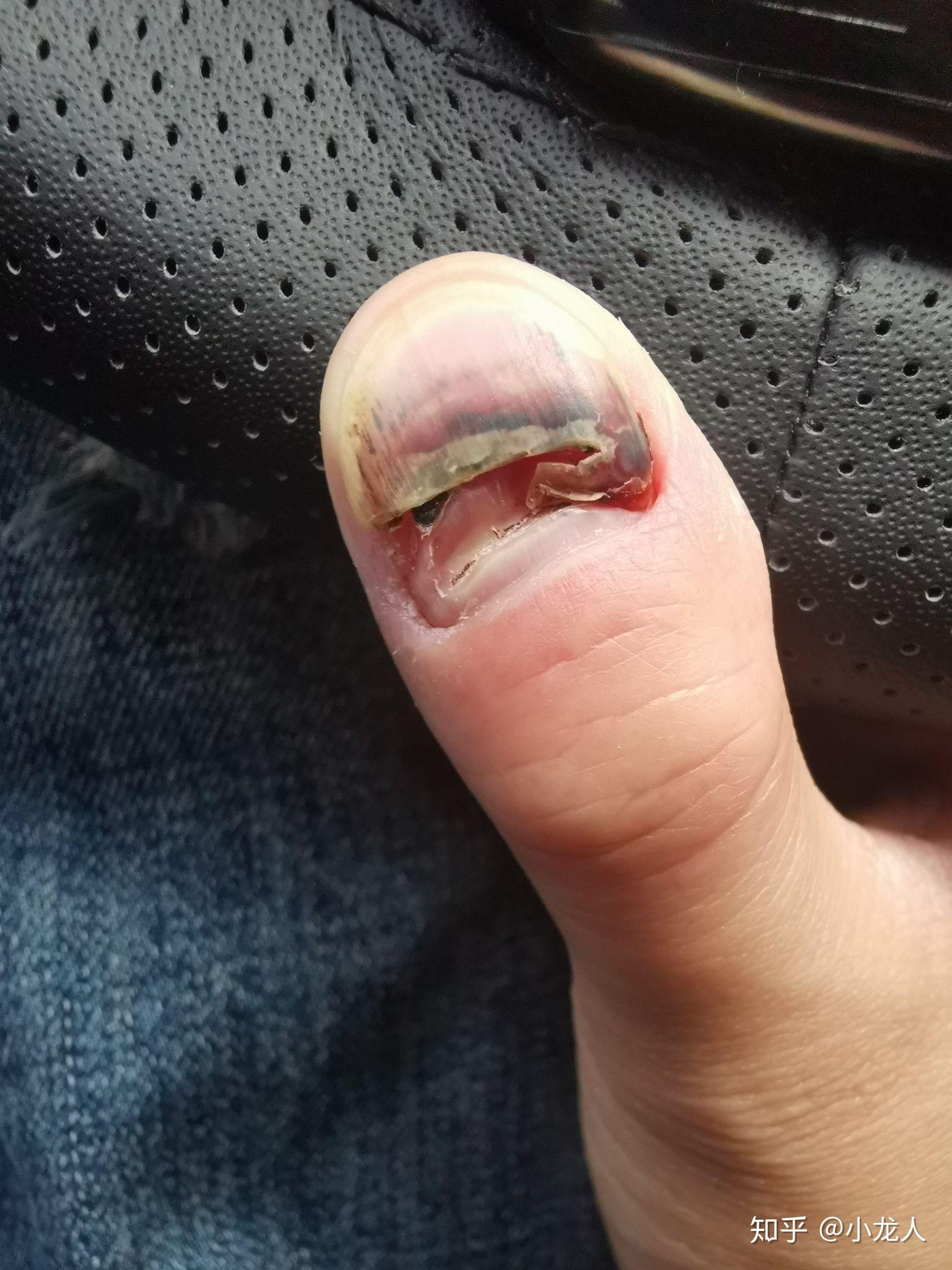 手指被门夹了,然后指甲里面四分之一有淤血,都两个月了还没好,怎么办?