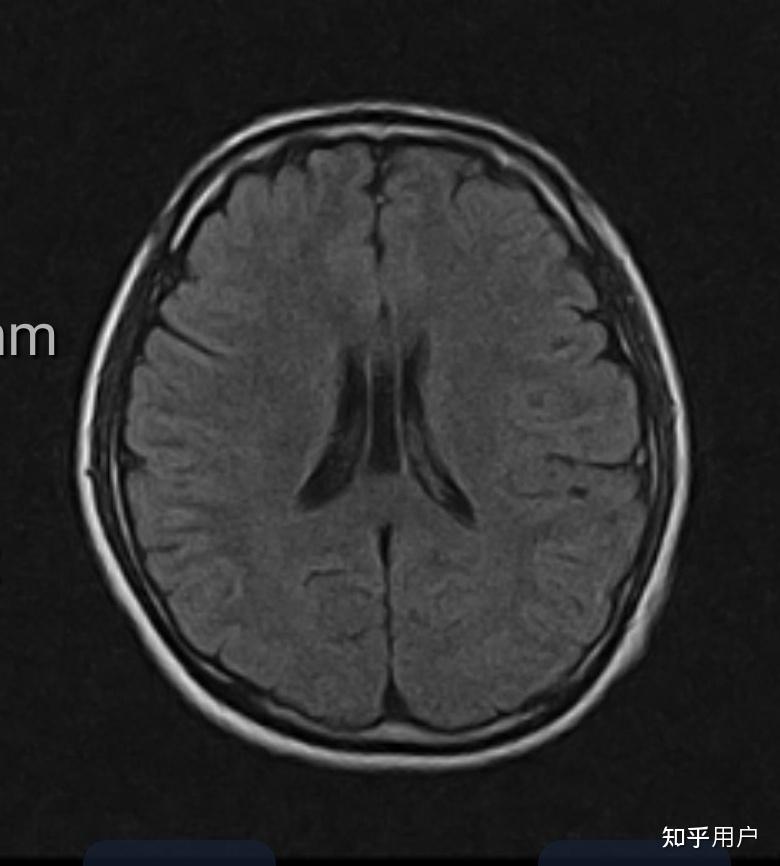 拥有透明隔囊肿或第五脑室的人, 是不是特别聪明 ? - 知乎