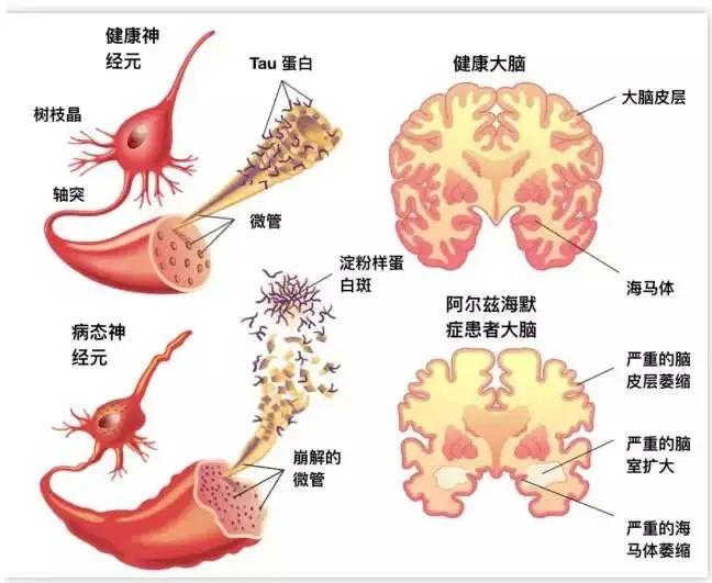 大脑里的"老年斑"