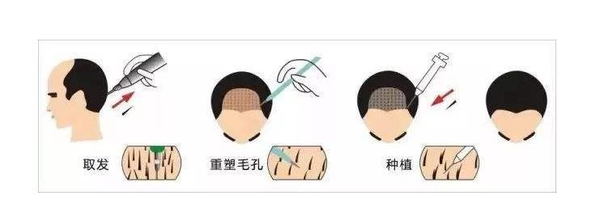 植发避坑指南，植发前一定要知道这些！少花好几千！植发技术，植发避坑 - 知乎
