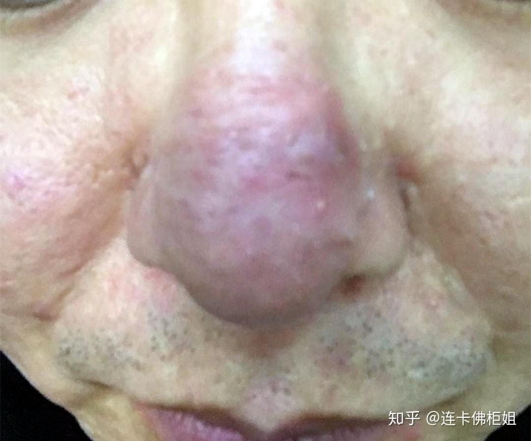 怎么去黑头不伤害毛孔 v2-859877091ed697849cea4e299974e948_r.jpg