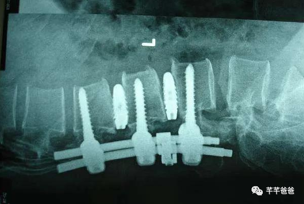 程序员腰突经历分享(中) 程序员腰突经历分享(中)
