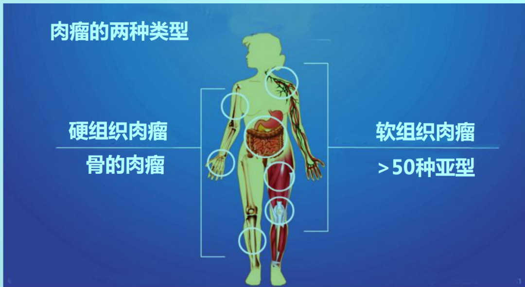 关于软组织肉瘤的常见问题 知乎