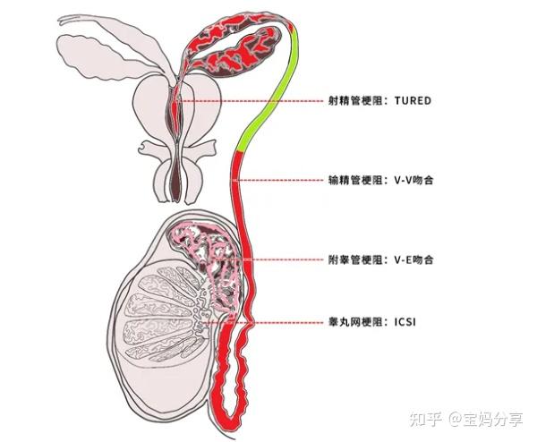 (2)精道梗阻如先天性阴茎缺,如阴茎过小,男性假两性畸形,尿道上裂或