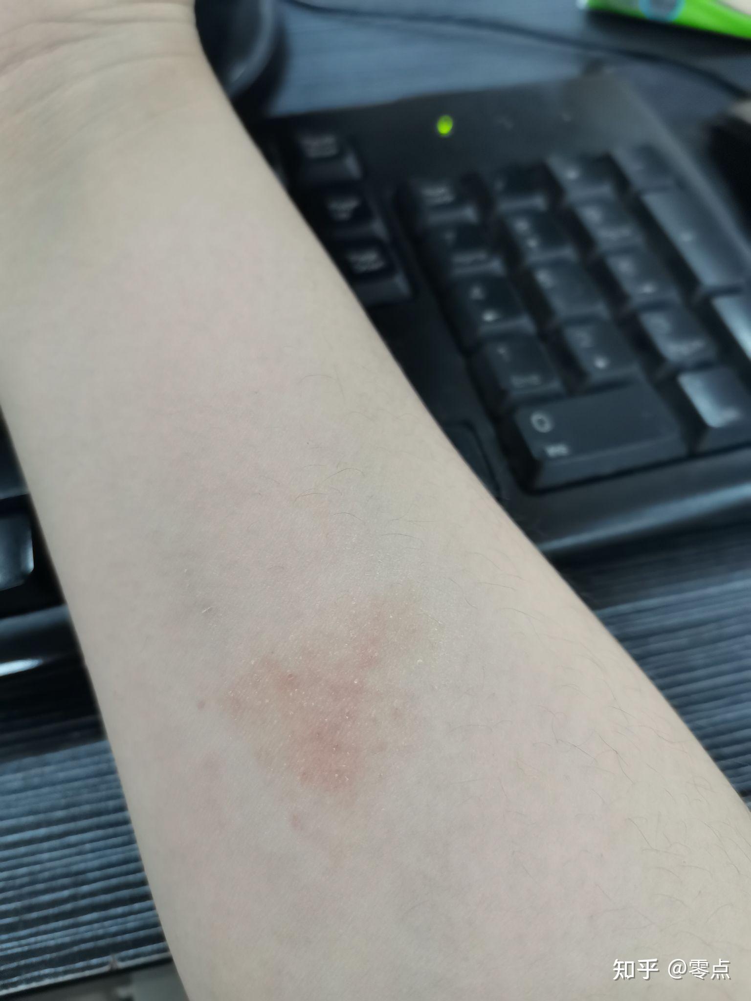 手臂上有一小块粗糙的皮肤偶尔痒像廯应该用什么药