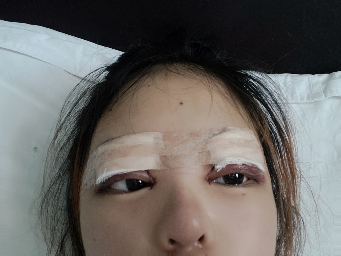 割眼皮 知乎