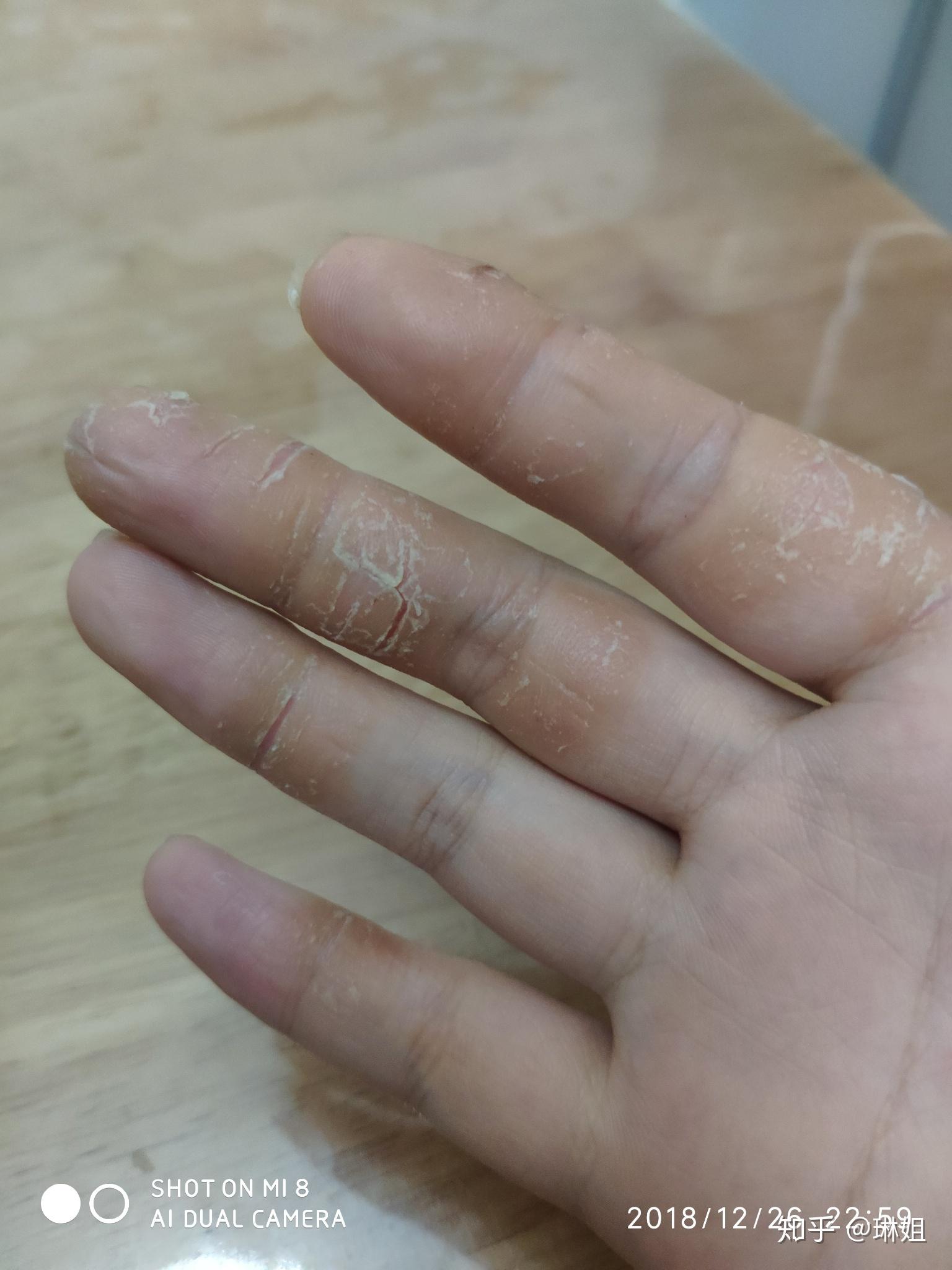 手上干裂型湿疹在哪里看比较好? - 知乎