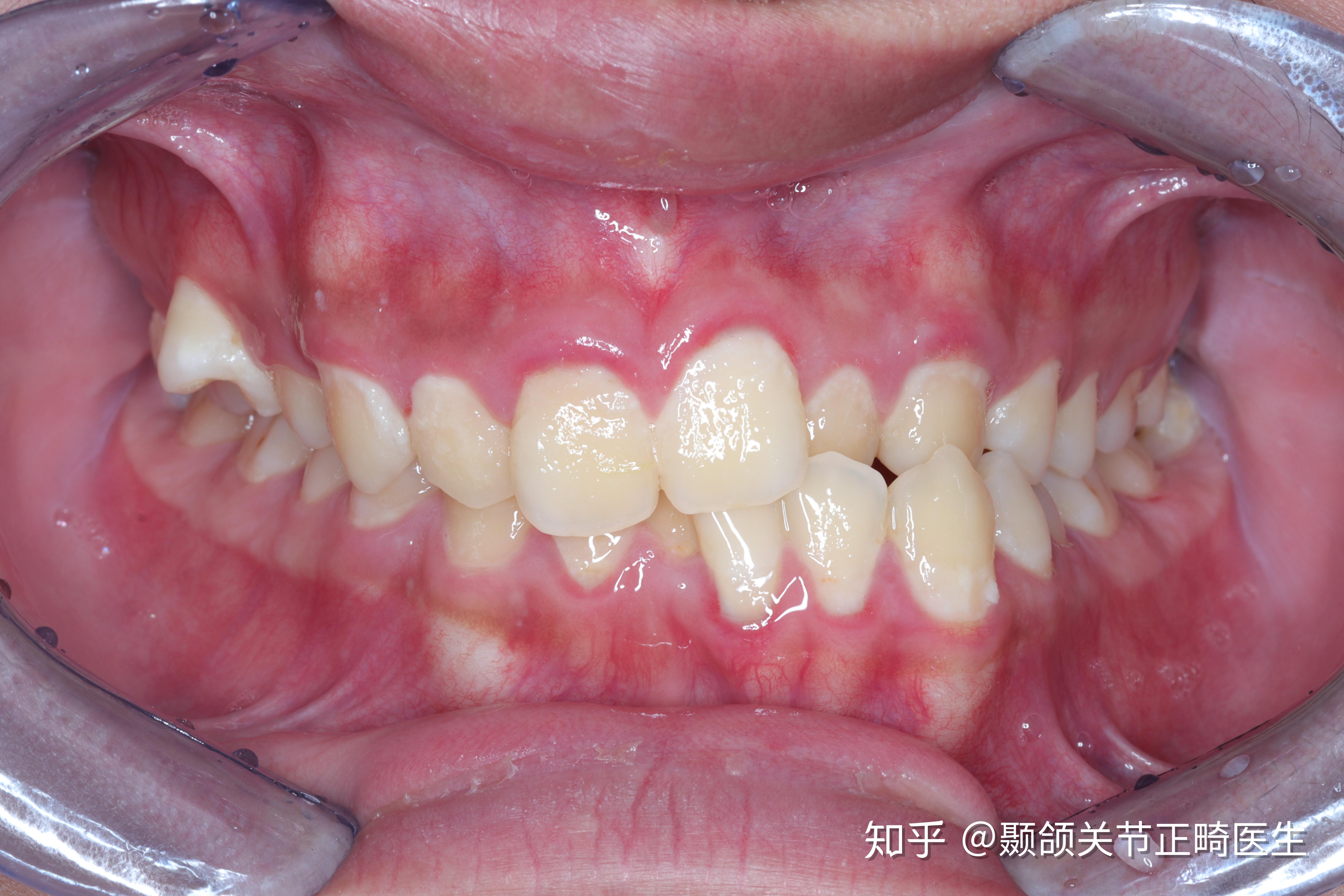 左边地包天右边天包地略微影响脸型整牙的话难度和风险大吗