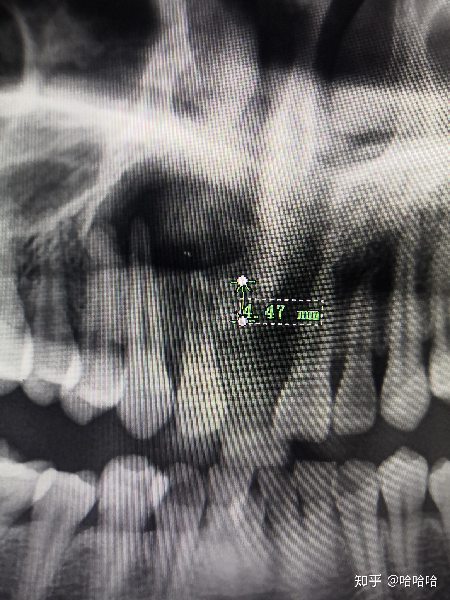 关注问题 67 写回答 登录/注册 牙医 牙齿 根管 根尖囊肿是硬的吗?