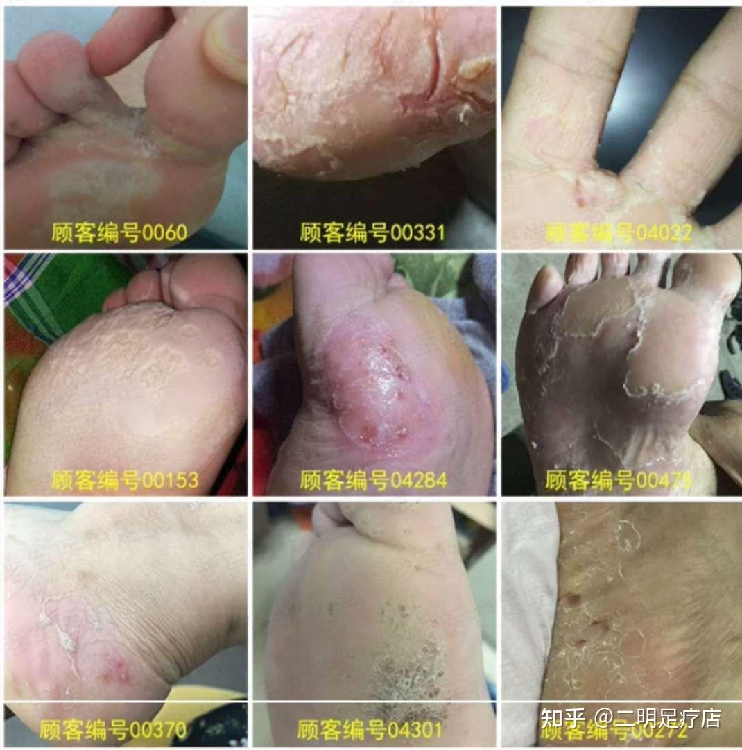 脚气粉 - 知乎